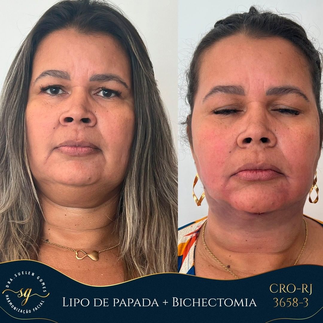 bichectomia