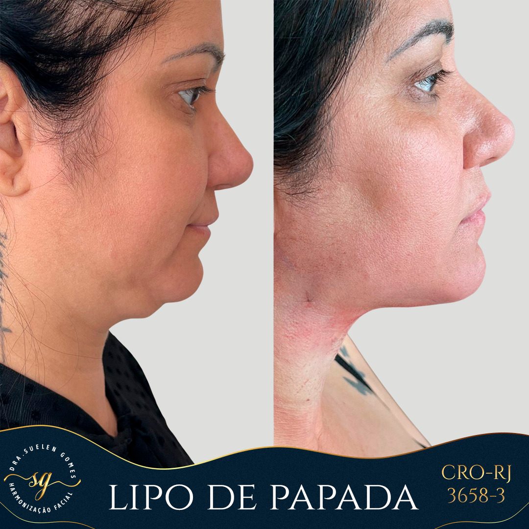 lipo de papada 1