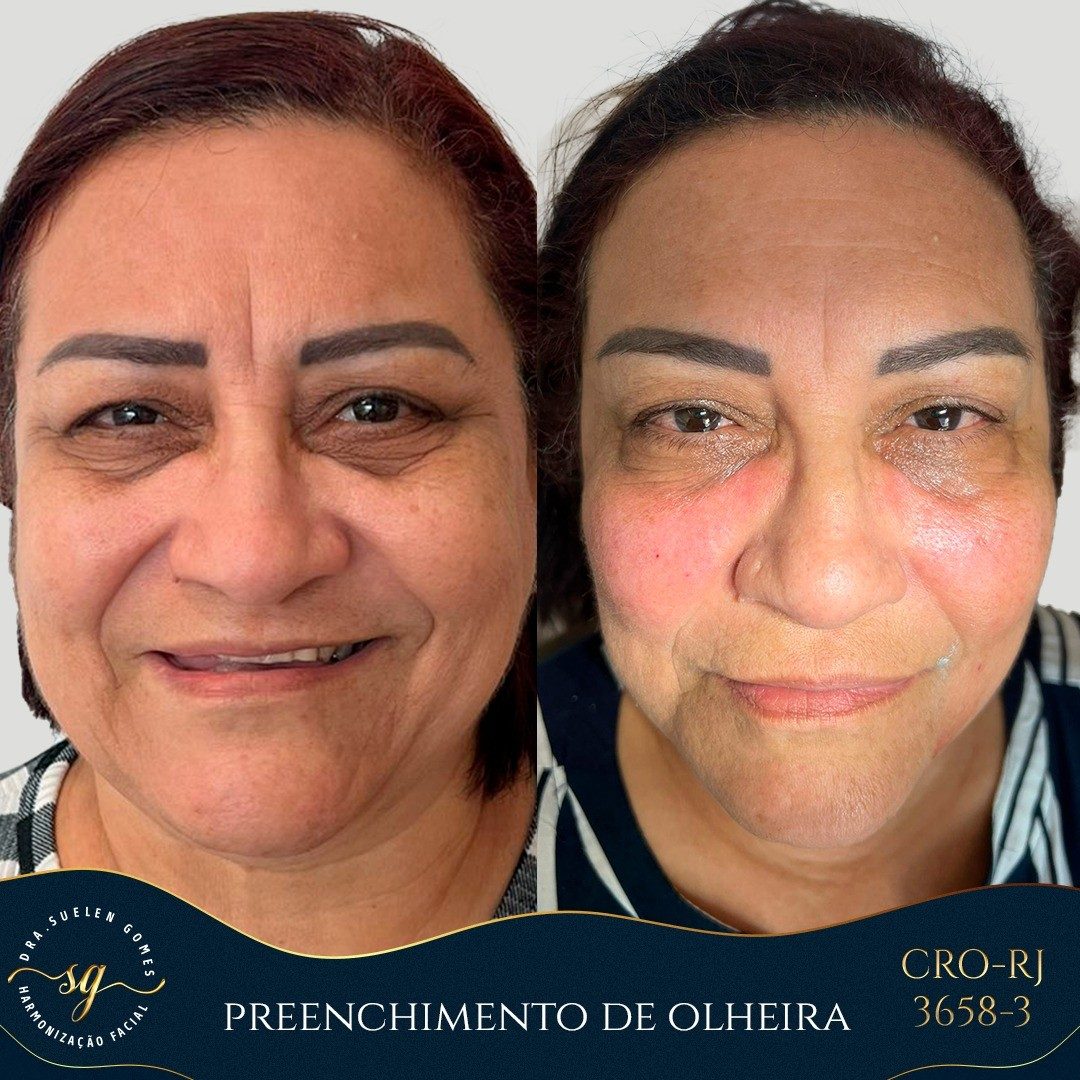 preenchimento de olheira