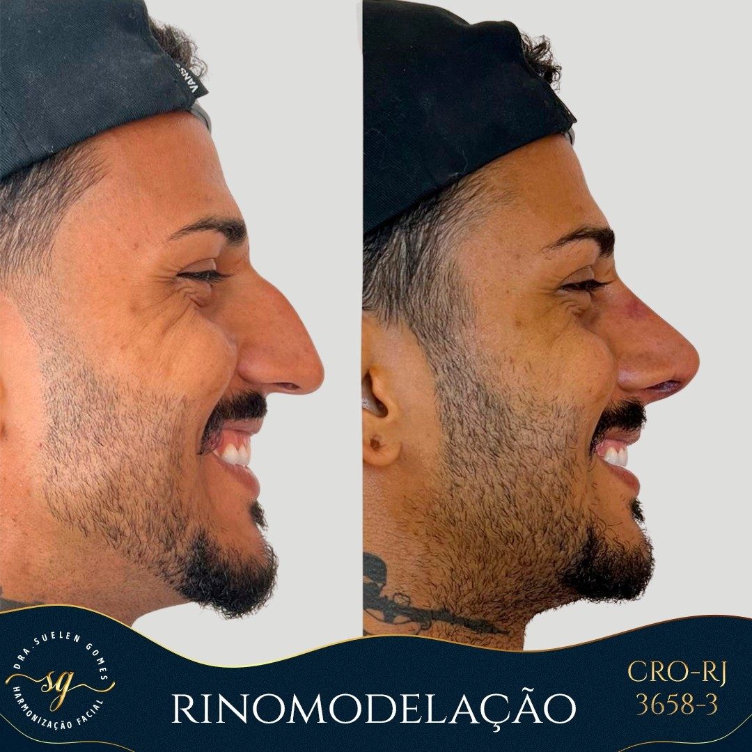 rinomodelação